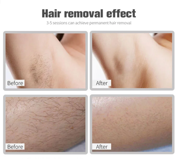 2025 Professional Hair Removal Laser 1800W Ice Titanium Laser Hair Removal 755 808 1064mm Diode Laser Hair Removal Machine Price